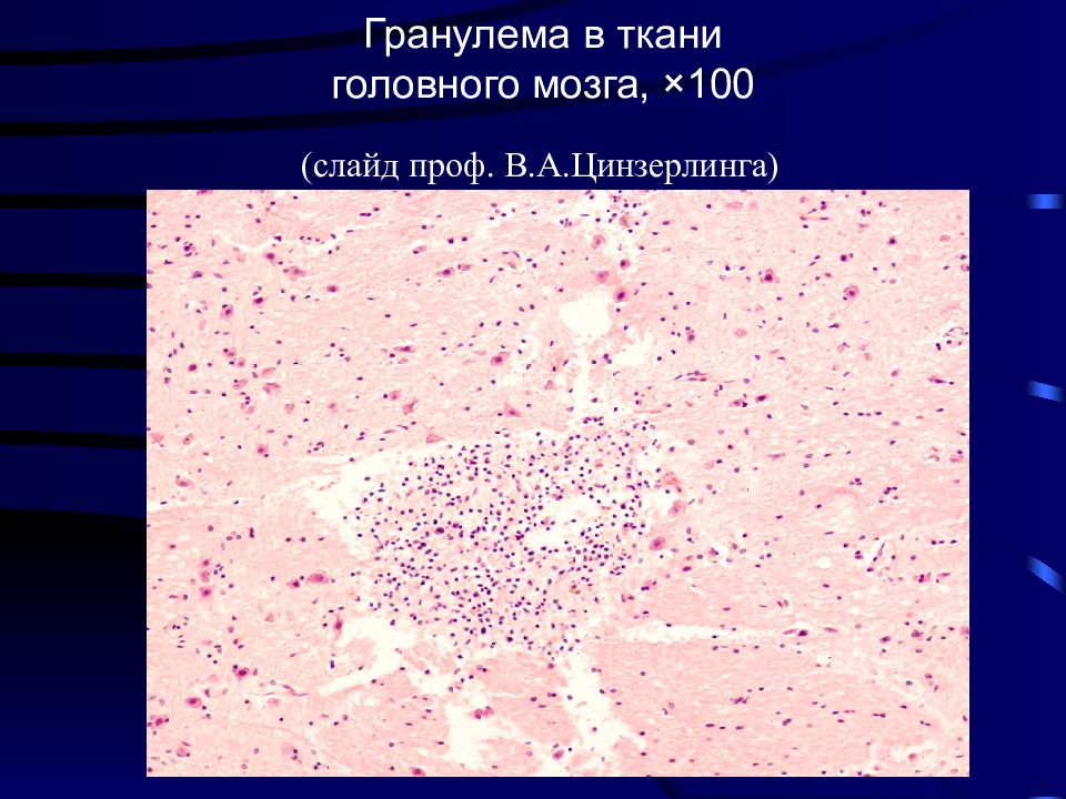 Гранулема при туберкулезе. Зоны гранулемы. Компоненты саркоидной гранулемы:. Эпителиоидноклеточные гранулемы. Зоны гранулемы.