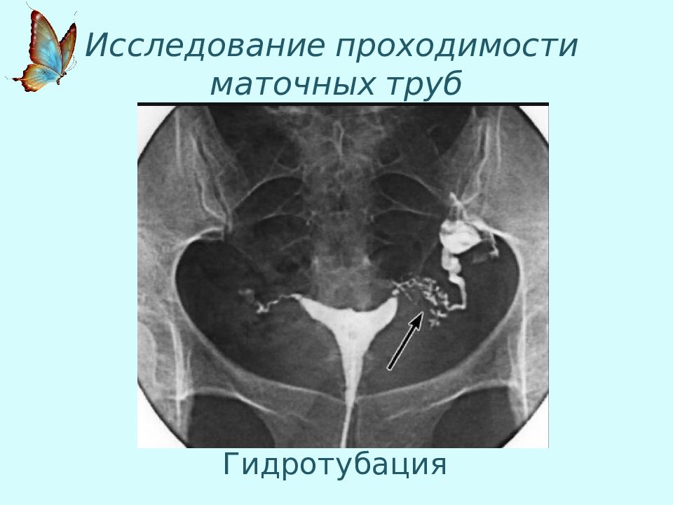 Проходимость маточных труб. Гидротубация маточных труб. Методы оценки проходимости маточных труб. Прибор для проходимости труб. Методы изучения проходимости маточных труб.