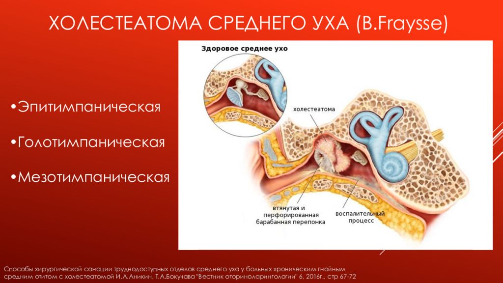 Холеастома. Холестеатоме среднего уха. Холестеатома среднее ухо. Холестеатома височной кости.