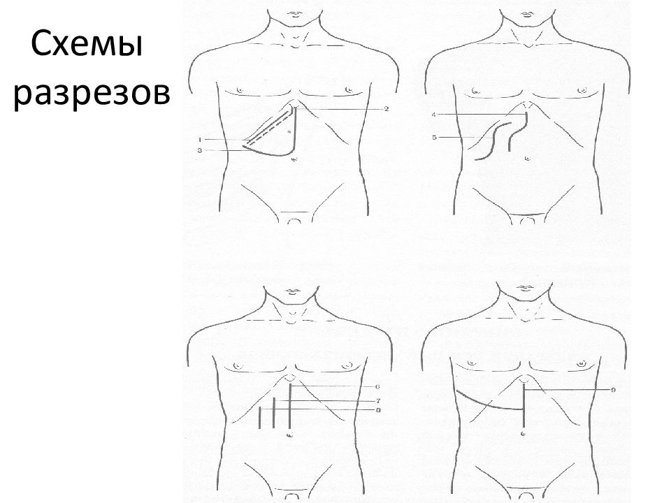 Топографическая хирургия. Схема разреза при маммопластике. Грудь в разрезе схема. Линии выреза схема. Подтяжка груди разрезы схема.