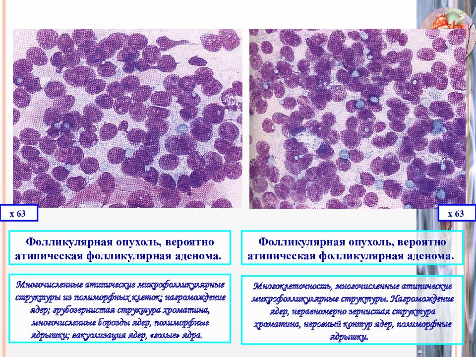 Цитологическая картина фолликулярной опухоли щитовидной железы что значит