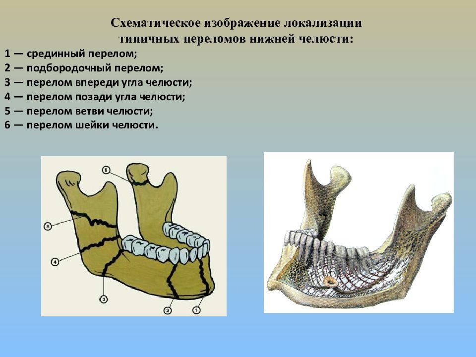 Методы временной и постоянной иммобилизации отломков челюстей презентация