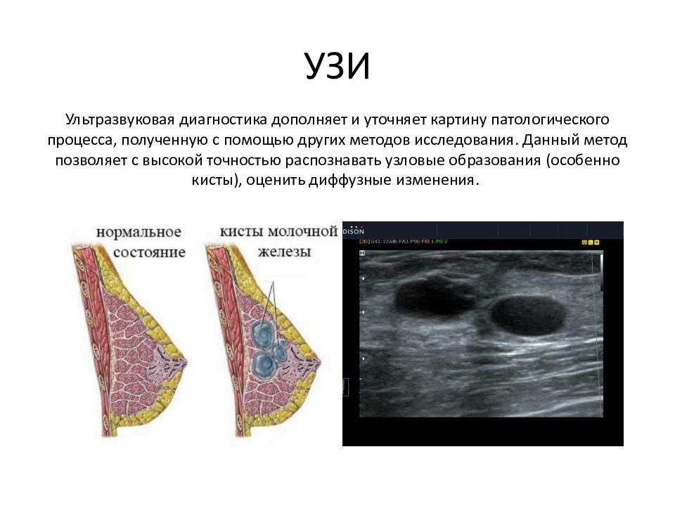 Кисты молочной железы презентация