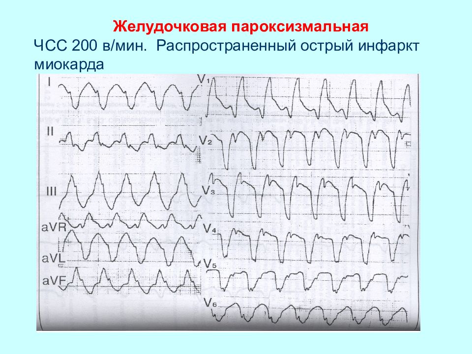 Экг при нарушениях ритма и проводимости презентация