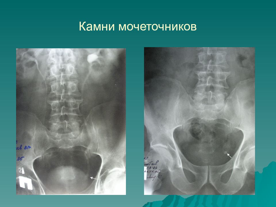 Картинка камень в мочеточнике