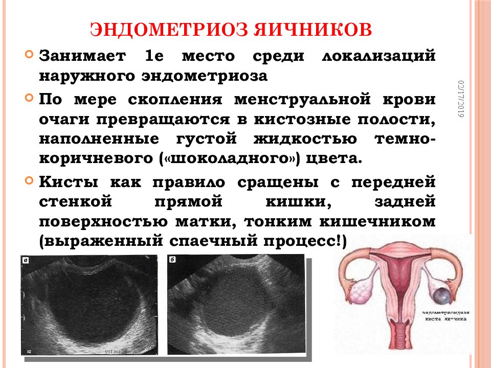 Кисты яичников презентация гинекология