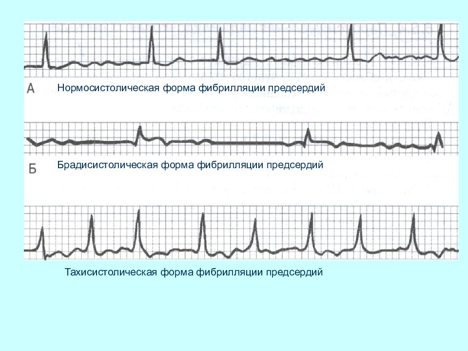 Пароксизмальная форма фибрилляции предсердий карта вызова скорой