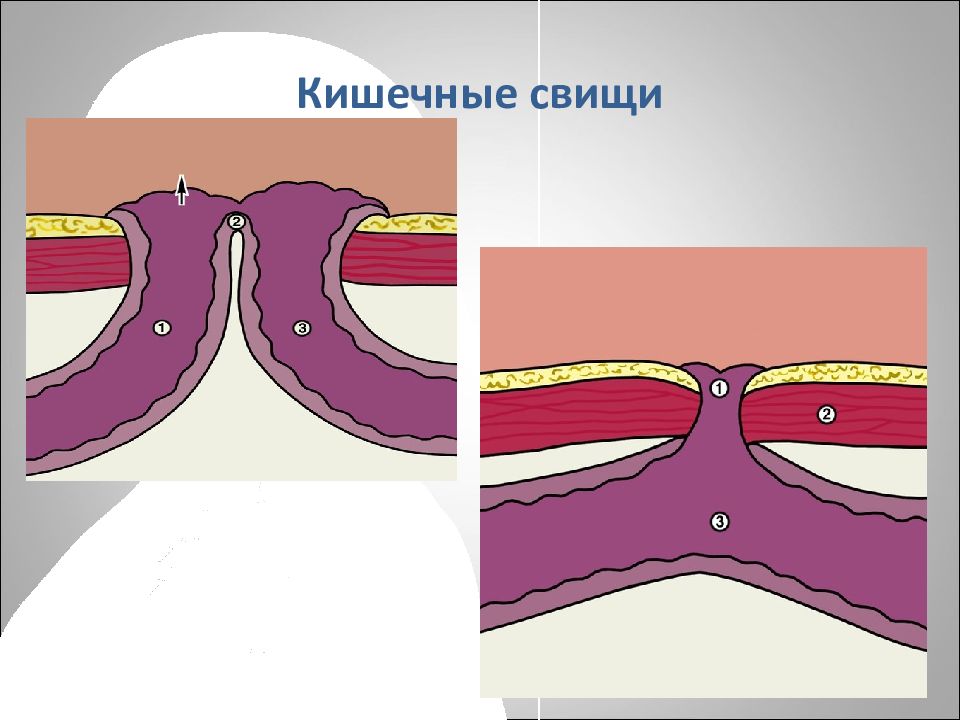 Свищи консервативное лечение. Эпителизированный свищ. Несформированные кишечные свищи. Губовидный кишечный свищ.