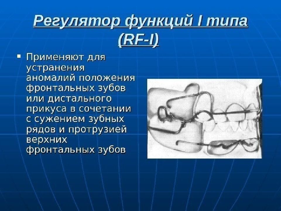 Регулятор функций 1 типа. Глубокий прикус презентация. Аппараты для лечения глубокого прикуса. Регулятор функции Френкеля для сужения зубных рядов.