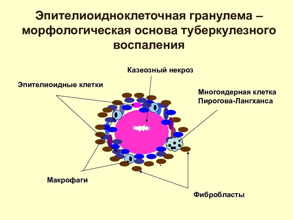 Туберкулезная гранулема рисунок