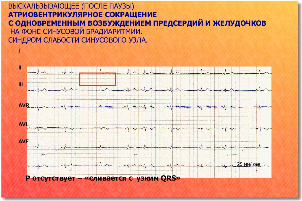 Нарушение синусового. Ритм предсердий и ритм желудочков. Паузы на фоне синусового ритма. Одновременное возбуждение предсердий и желудочков. Ритм синусовая брадиаритмия что это.