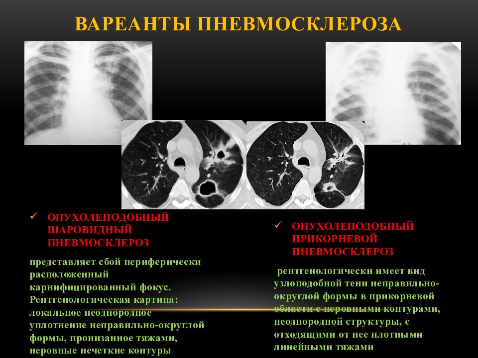 Диффузный пневмосклероз это рак. Локальный пневмофиброз кт. Кт признаки пневмофиброза. Инволютивный пневмосклероз. Посттуберкулезный пневмофиброз.