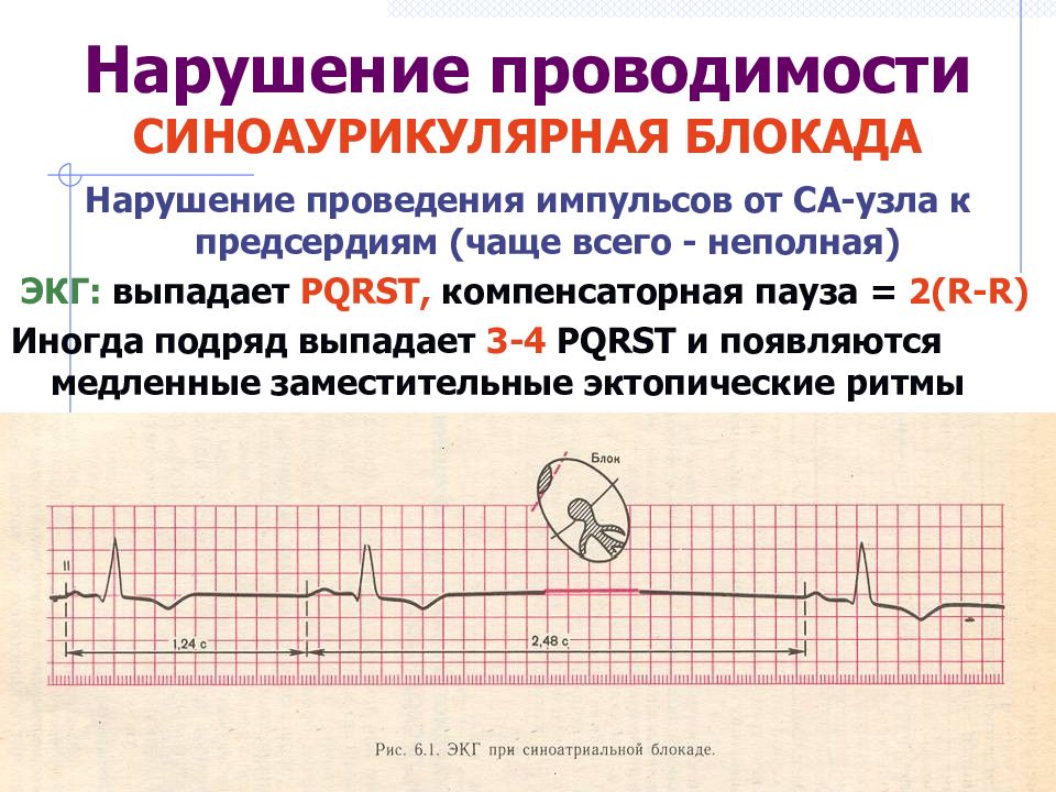 Экг при нарушениях ритма и проводимости презентация