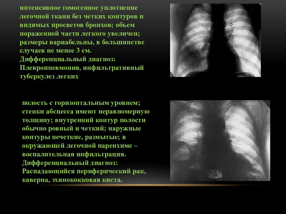 Уплотнение легочной ткани. Уплотнение легочной ткани на рентгене. Лёгочная ткань уплотнена. Уплотнения легочной ткани без четких контуров. Синдром легочного инфильтрата.