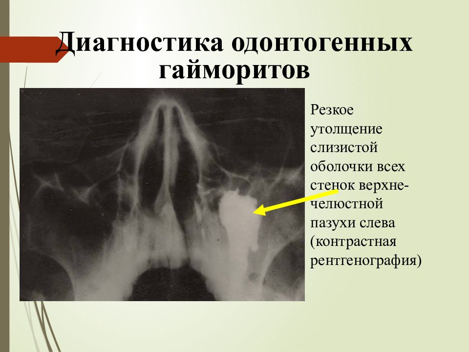 Одонтогенный синусит презентация