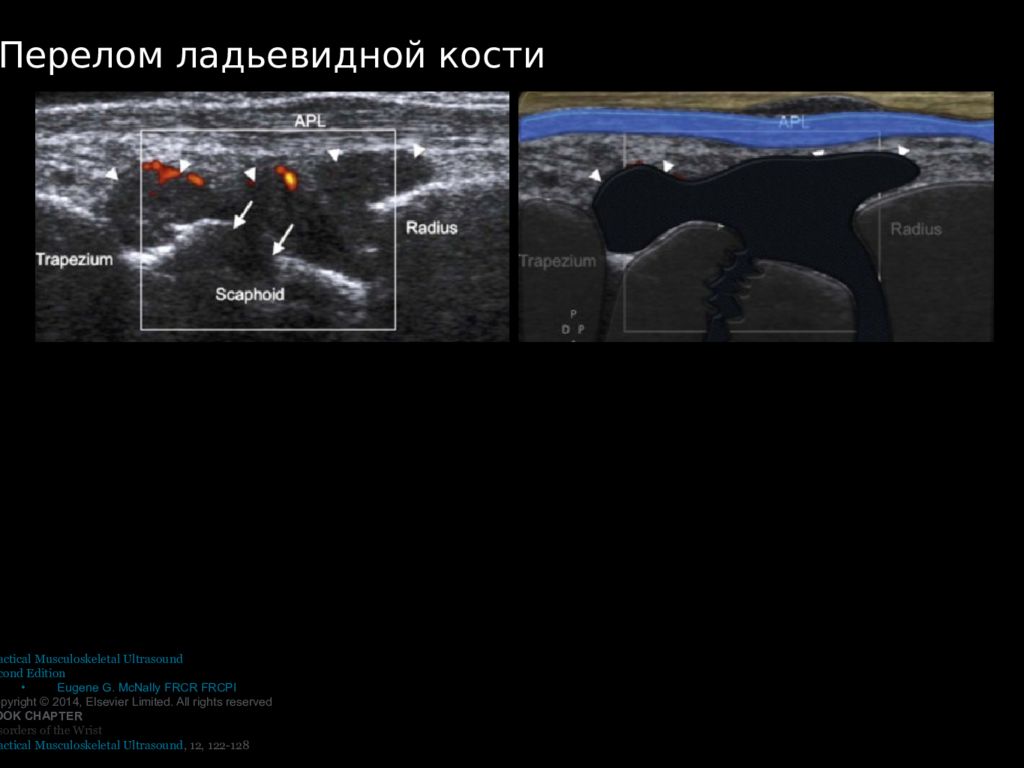 Узи кисти. Ультразвуковое исследование кисти. Перелом ладьевидной кости кисти УЗИ картина.