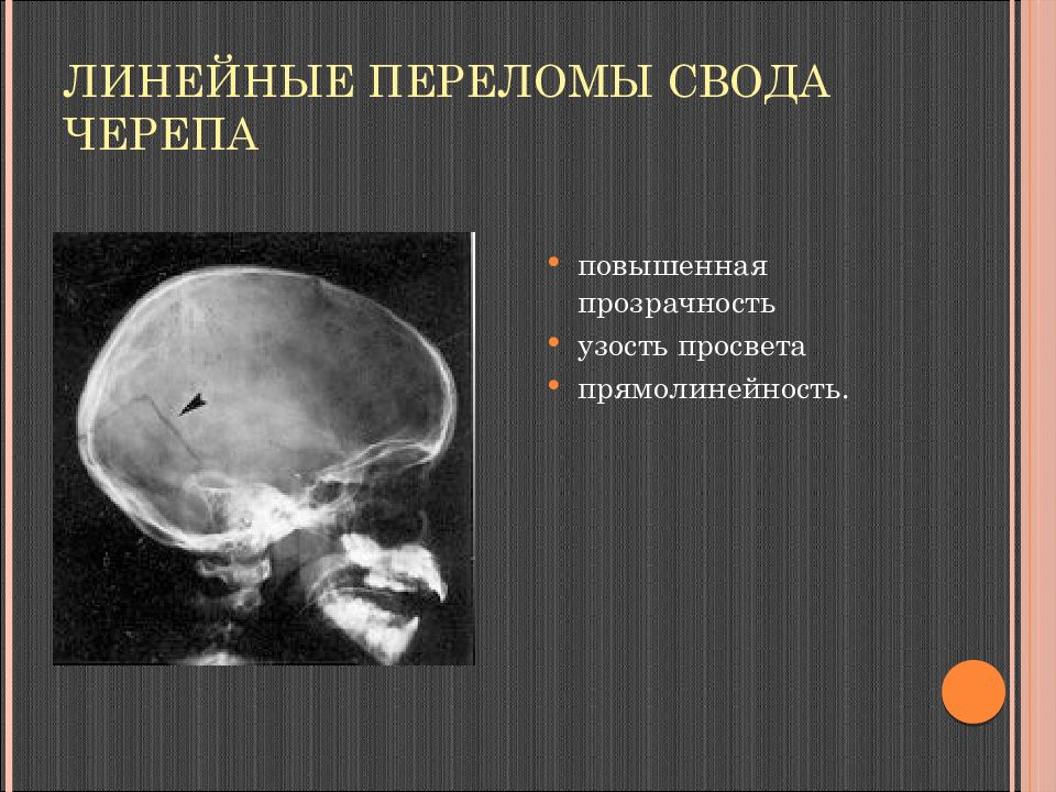 Линейная трещина. Линейный перелом теменной кости. Перелом кости основания черепа. Линейный перелом свода черепа. Перелом костей свода черепа.