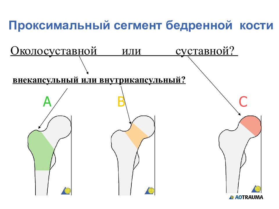 Бедренный отдел. Перелом дистального отдела бедренной кости классификация. Классификация переломов бедренной кости. Классификация переломов проксимального отдела бедренной кости. Переломы проксимального отдела бедренной кости.