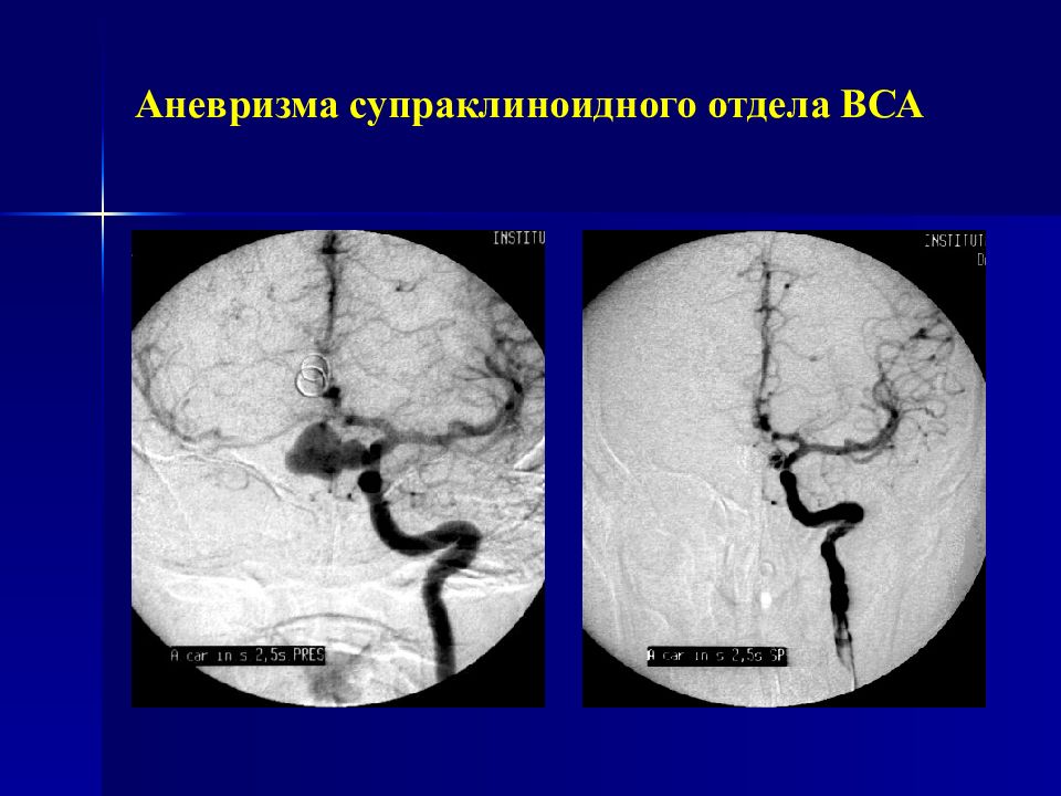 Мешотчатые аневризмы вса. Сегменты внутренней сонной артерии кт. Фузиформное расширение внутренней сонной артерии. Аневризма внутренней сонной артерии кт. Супраклиноидная аневризма.