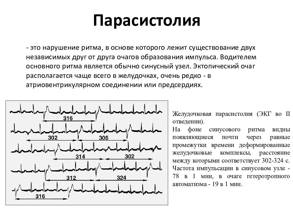 Приказ экг. ЭКГ-критерии парасистолии. Сливная экстрасистолия на ЭКГ. Сливная желудочковая экстрасистола. ЭКГ критерии парасистолии желудочковой.