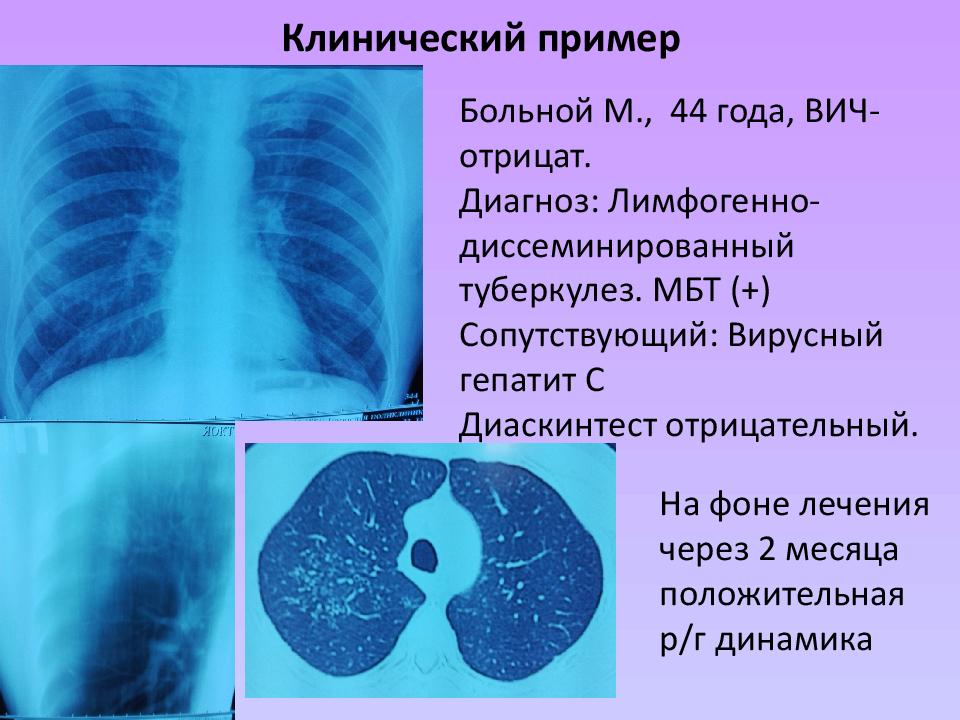 Защита от туберкулеза