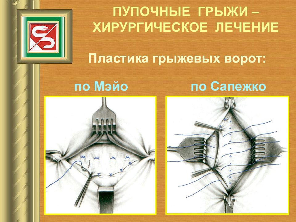 Пластика по мейо картинки