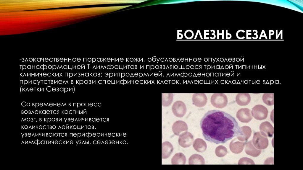 Синдром сезари по утвержденным тесты с ответами. Формы хлл. Синдром сезари по утвержденным тесты с ответами. Синдром сезари т клеточная лимфома. Лимфома синдром сезари.