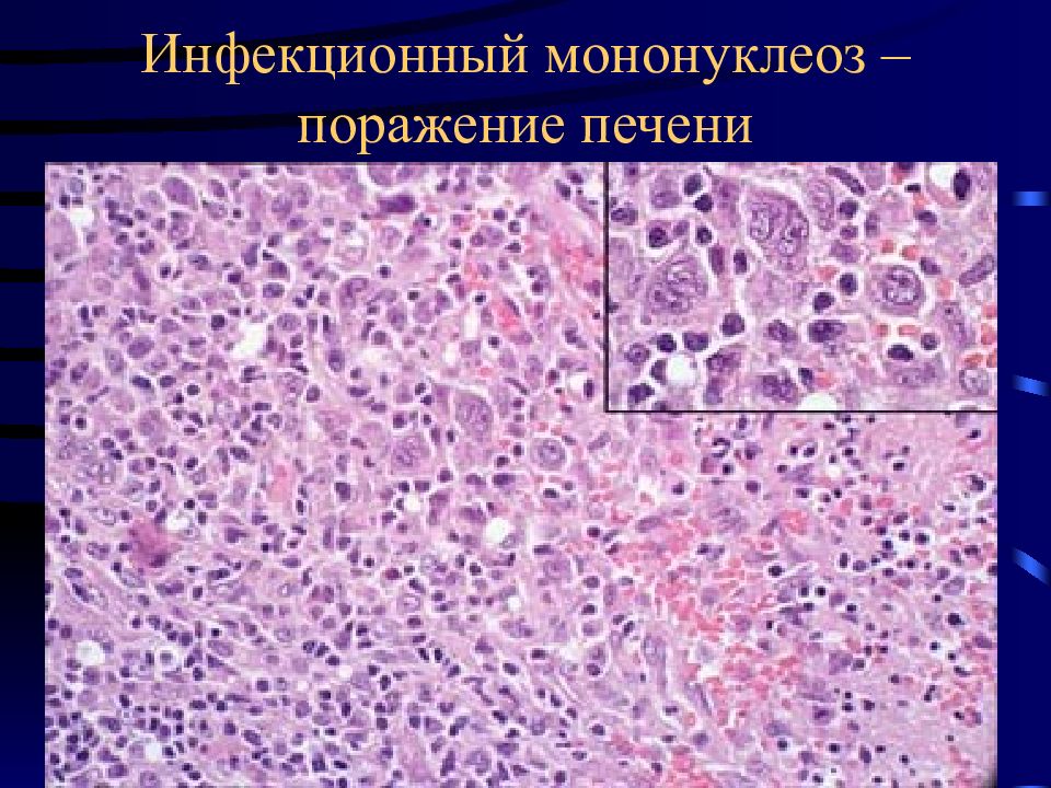 Менингококковая инфекция патологическая анатомия презентация