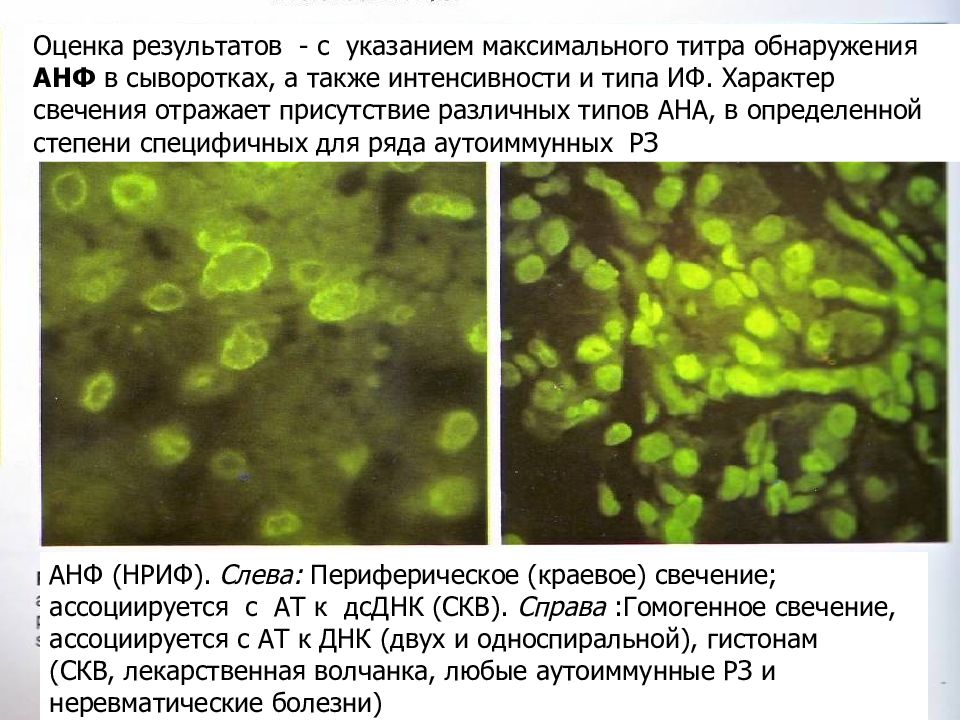 Антинуклеарный фактор. Анф при системной красной волчанке. Антинуклеарный фактор при СКВ. Анф мелкогранулярный Тип свечения. Типы свечения антинуклеарного фактора.