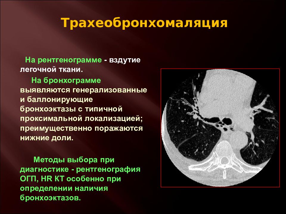 Врожденные заболевания легких. Трахеобронхомаляция рентген кт. Трахеобронхомаляция у детей презентация. Трахеобронхомаляция у детей кт.