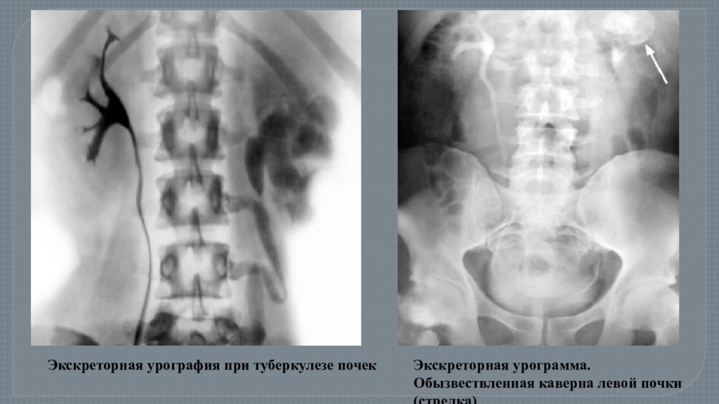 Урография Вен Плвого Члена