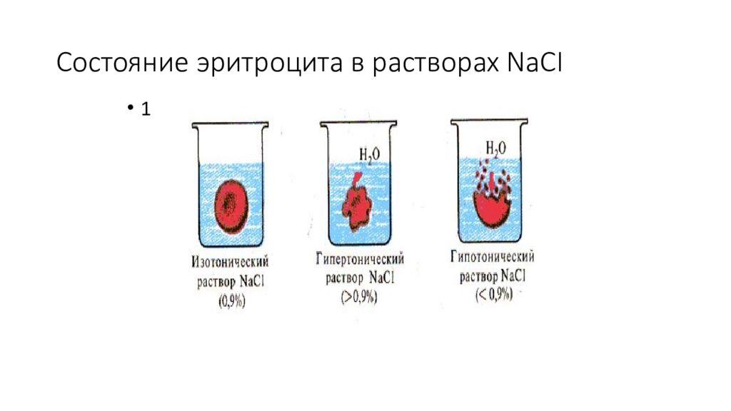 Какие соли в крови. Эритроциты в гипотоническом растворе. Гемолиз эритроцитов в гипертоническом растворе. Концентрация NACL В гипертоническом растворе. Гипертонический раствор 7.5.