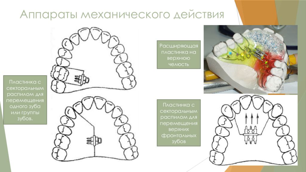 Ортодонтические аппараты механического действия презентация