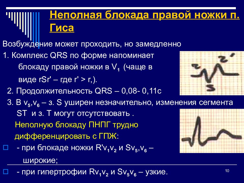 Неполная блокада правой ножки пучка гиса фото