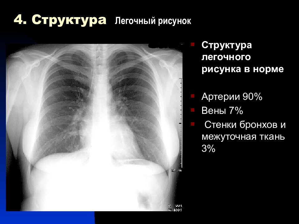 Легочный рисунок рентген. Легочной рисунок в норме на рентгене. Лёгочный рисвнок в норме. Структуры легочного рисунка. Нормальный легочный рисунок.