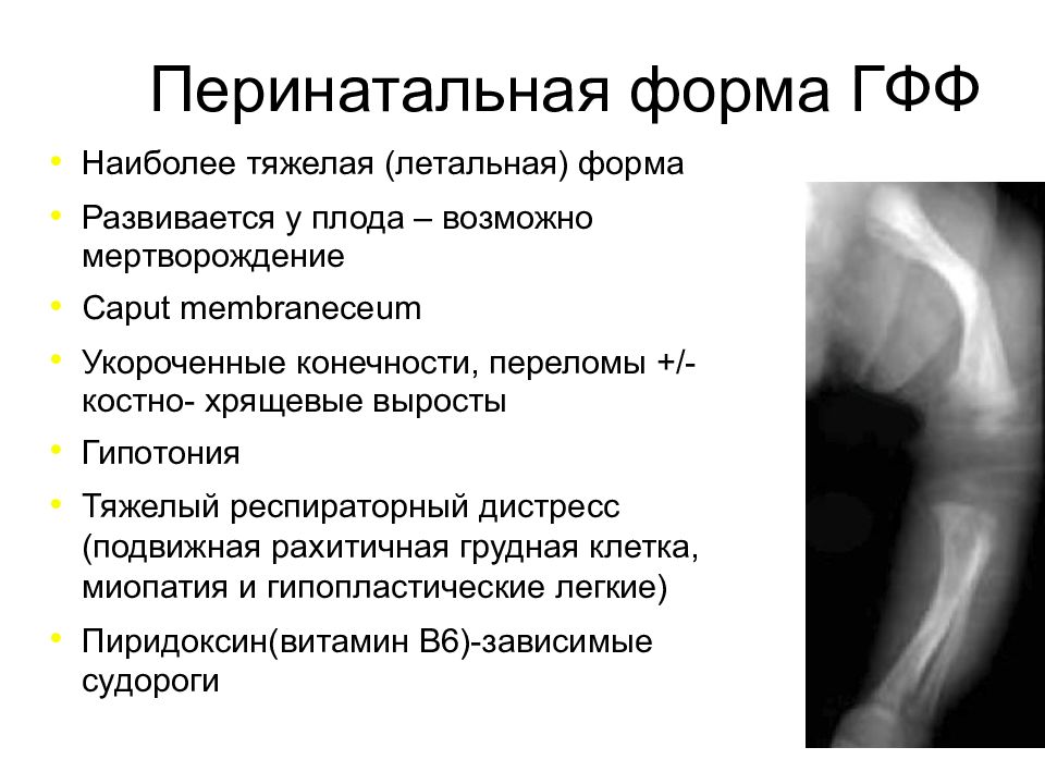 Заболевания скелета у детей. Гипофосфатазия симптомы у детей. Гипофосфатазия классификация. Гипофосфатазия у взрослых.