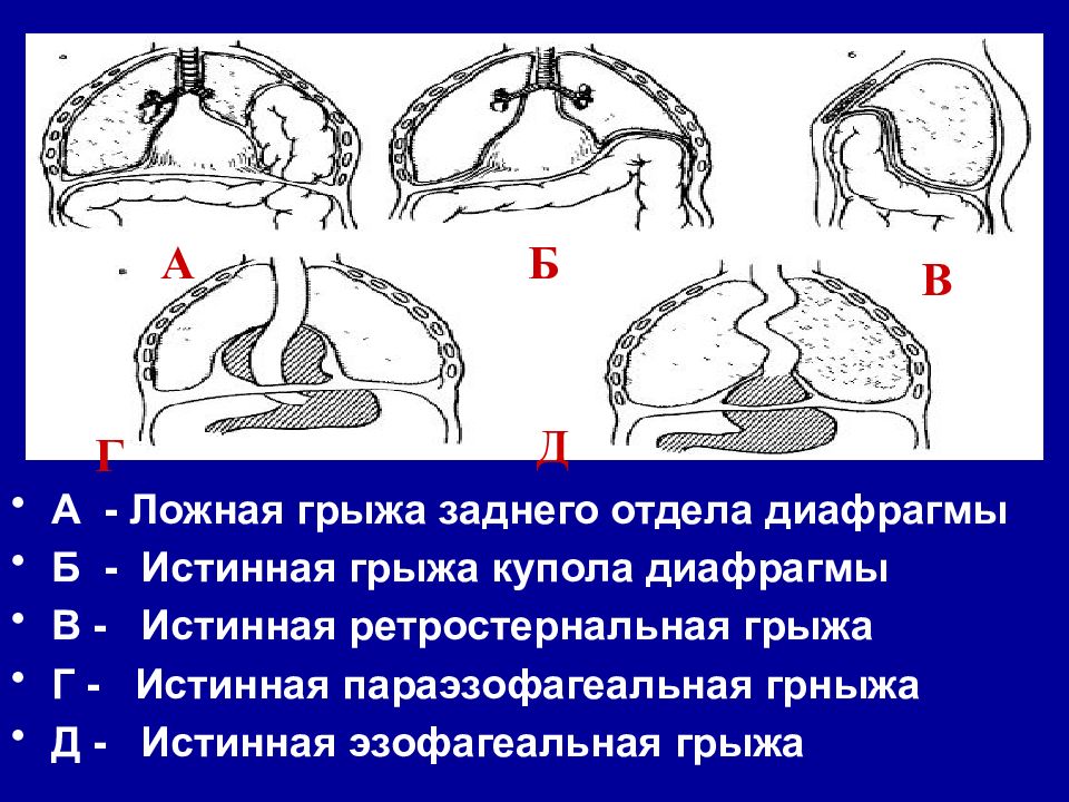 Диафрагмальная грыжа. Парастернальная диафрагмальная грыжа. Врожденная диафрагмальная грыжа. Левосторонняя врожденная диафрагмальная грыжа. Врожденные диафрагмальные грыжи у детей.