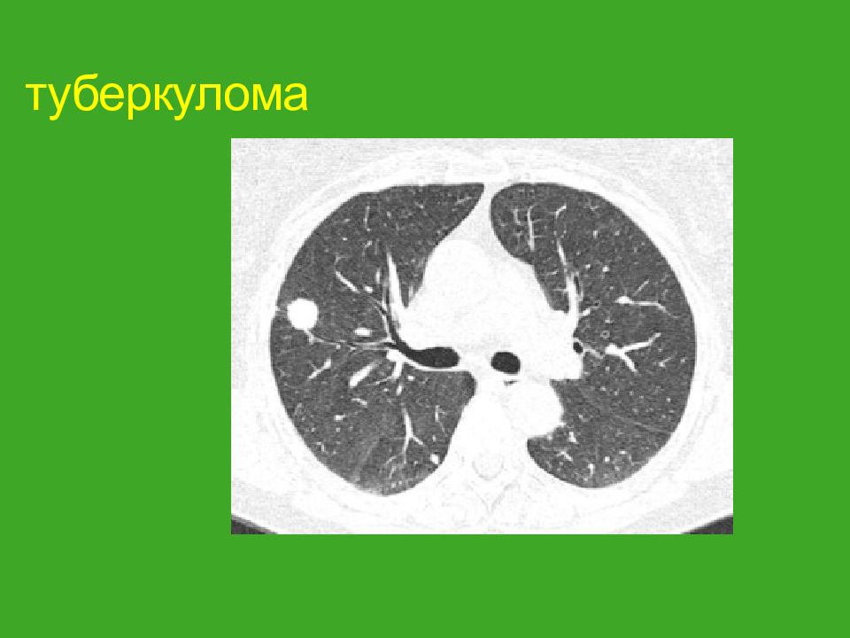 Туберкулома. Кальцинированная туберкулема на кт. Туберкулома на кт. Конгломератная туберкулома. Конгломератная туберкулома рентген.