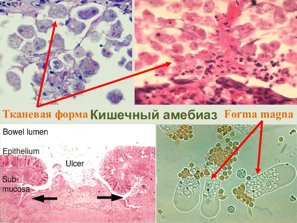 Клиническая картина в острый период амебиаза