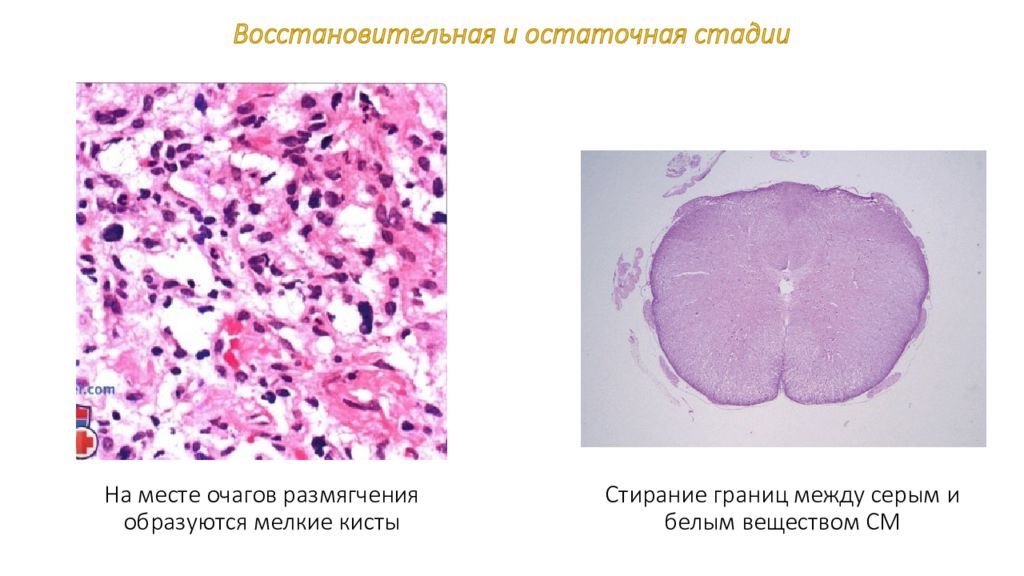 Полиомиелит патологическая анатомия презентация