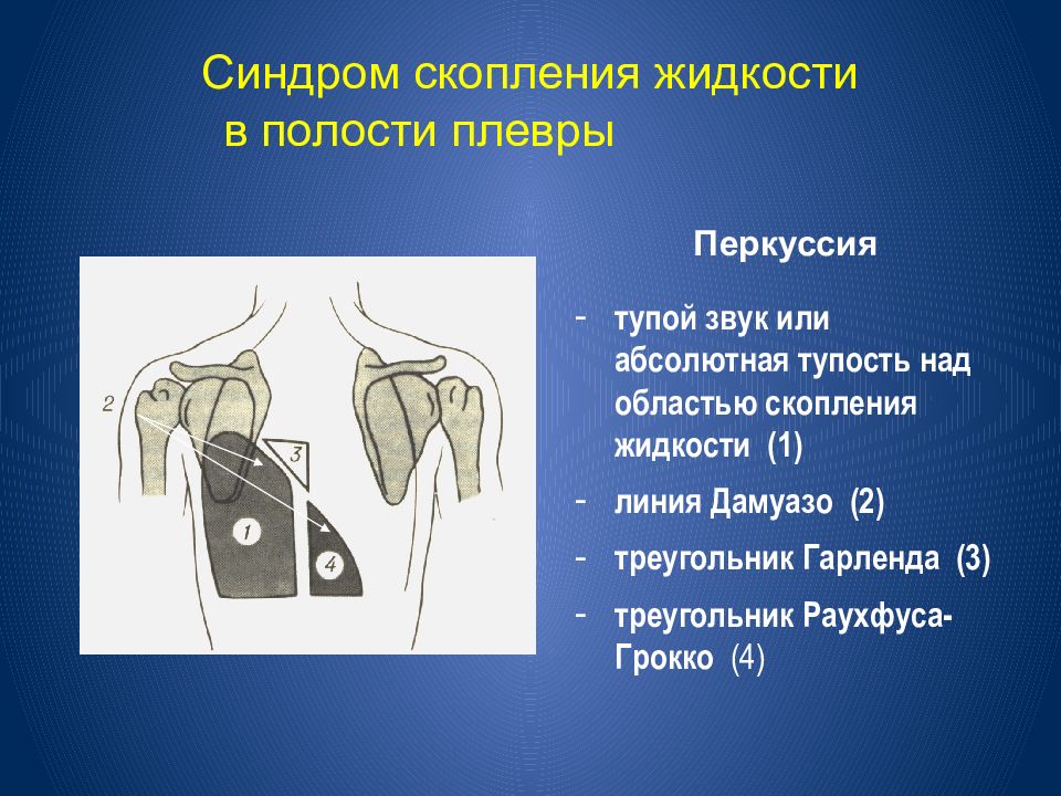 Жидкость в полости. Гидроторакс линия Дамуазо. При скоплении жидкости в плевральной полости перкуторный звук. Гидроторакс перкуторный звук. Перкуторный звук при жидкости в плевральной полости.