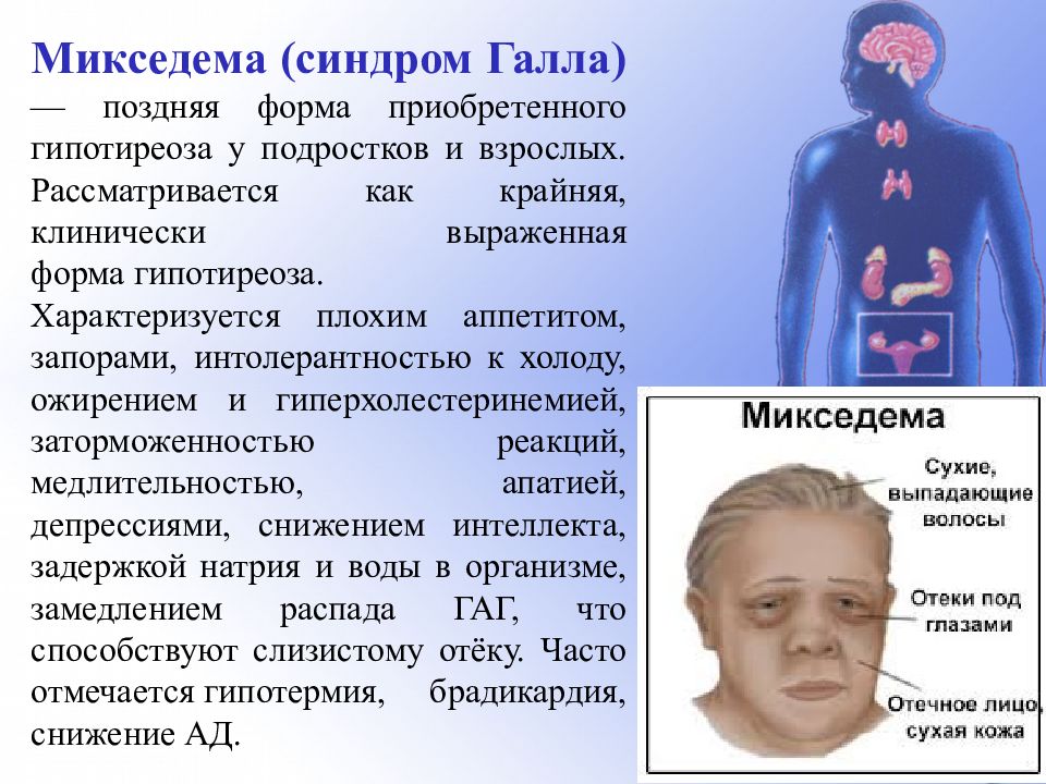 Приобретенные синдромы. Микседема болезнь симптомы.