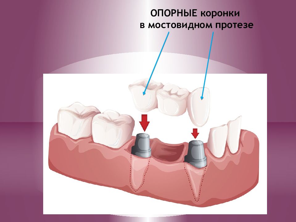 Искусственные коронки презентация