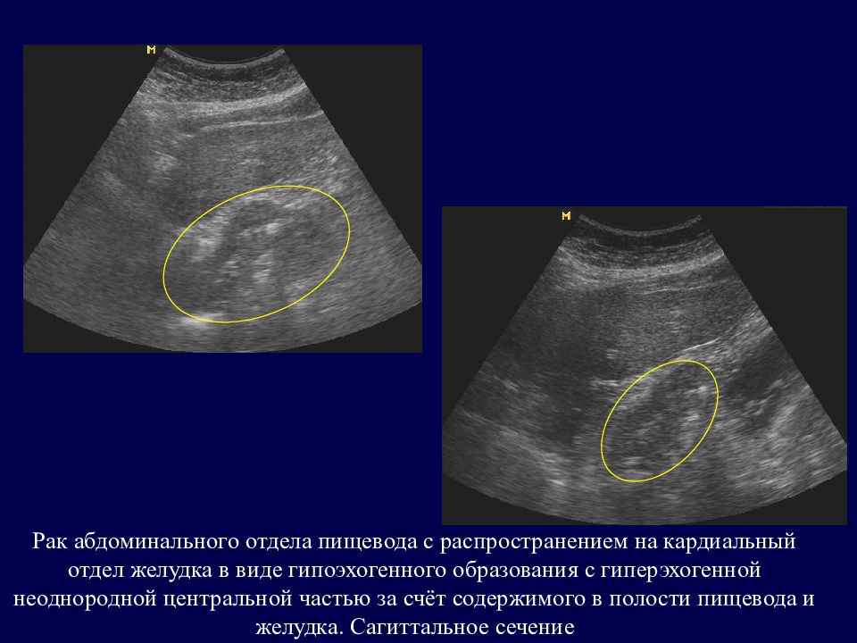 Что такое гиперэхогенное образование. Гиперэхогенное неоднородное образование в печени. Гипоэхогенные образования. Гипоэхогенное образование. Гипоэхогенное неоднородное образование.