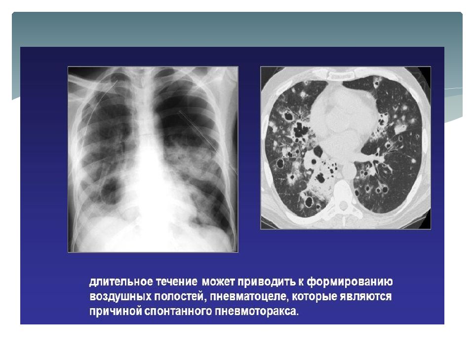 Пневмоцистная пневмония. Пневмония у ВИЧ инфицированных на кт. Пневмоцистная пневмония на кт. Пневмоцистная пневмония на кт легких. Пневмоцистная пневмония кт кт.