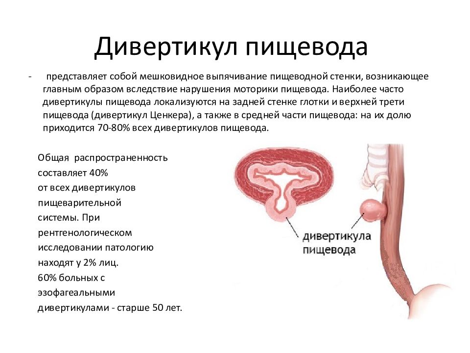 Дивертикулы пищевода презентация