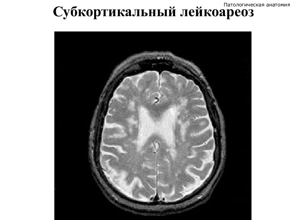 Лейкоареоз головного мозга что