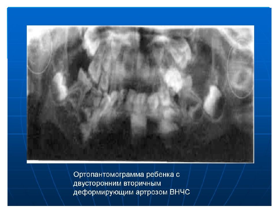 Тест рентгенологическая картина при артрозах внчс