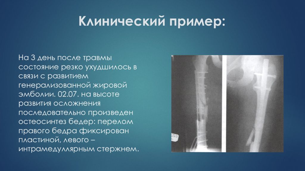 Патологический перелом. Жировая эмболия при переломах. Осложнения перелома бедра.