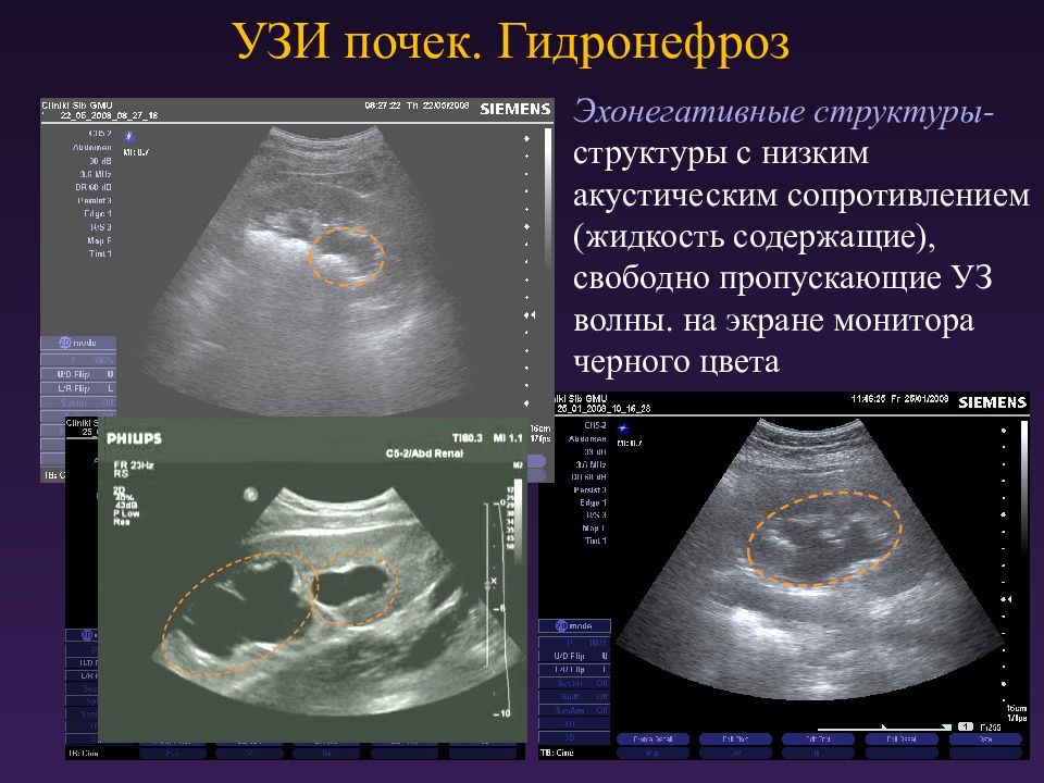 Что такое гидронефроз почки у взрослых. УЗИ почек гидронефроз 1ст. Гидронефротическая трансформация почки на УЗИ. УЗИ признаки гидронефроза почек. УЗИ почек гидронефроз заключение.